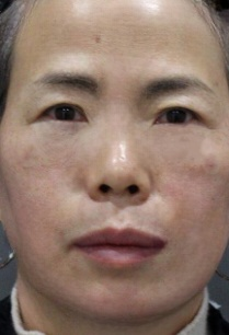 去眼袋手术