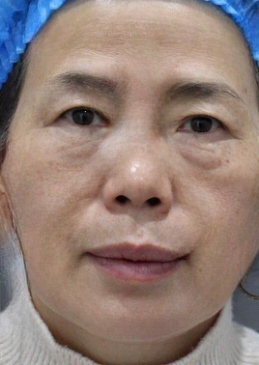 去眼袋手术