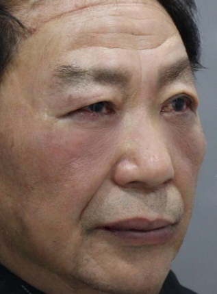 去眼袋手术