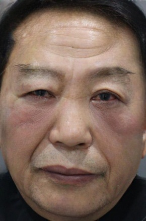 去眼袋手术