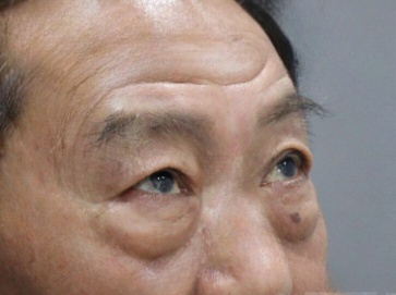 去眼袋手术