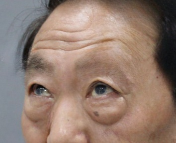 去眼袋手术