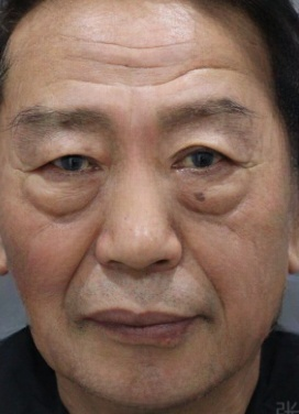 去眼袋手术