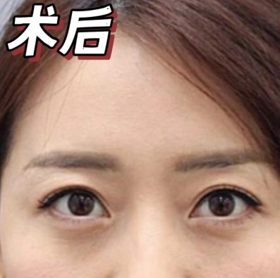 去眼袋手术