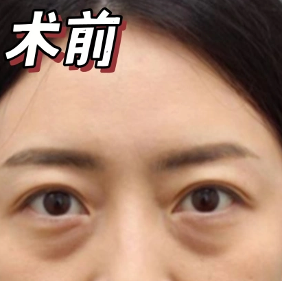 去眼袋手术