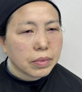 去眼袋手术