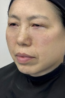 去眼袋手术