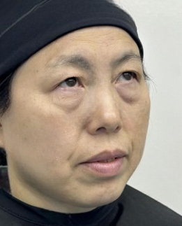 去眼袋手术