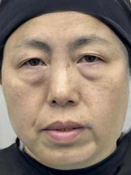 去眼袋手术