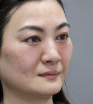 去眼袋手术