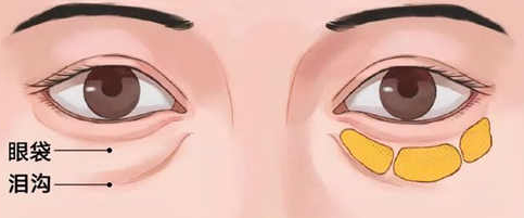 去眼袋手术