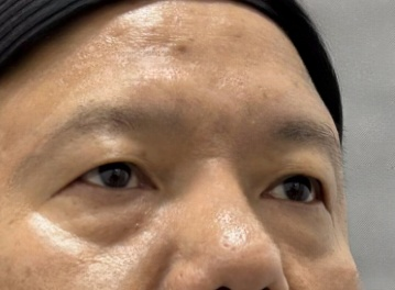 去眼袋手术