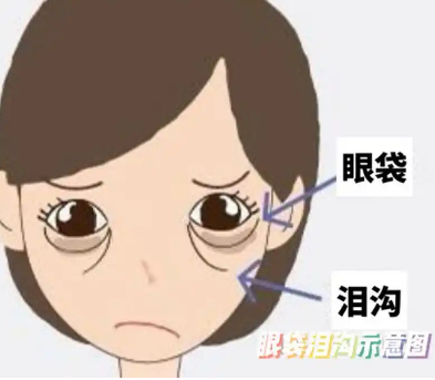 去眼袋手术