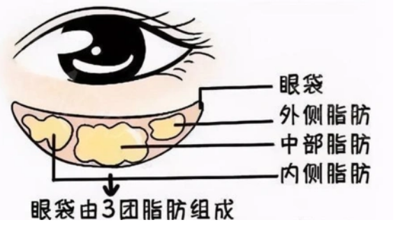 去眼袋手术