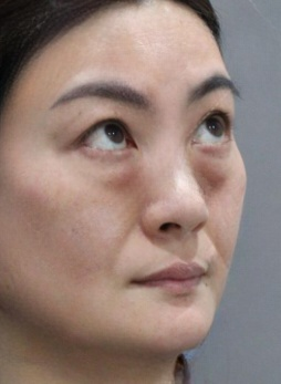 去眼袋手术