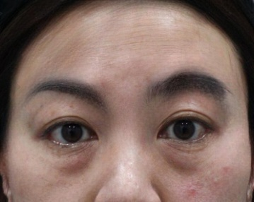 去眼袋手术