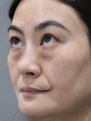 去眼袋手术