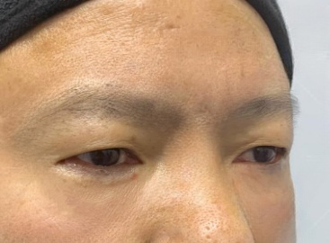 去眼袋手术