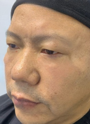 去眼袋手术