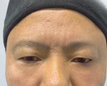 去眼袋手术