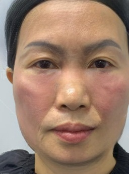 去眼袋手术