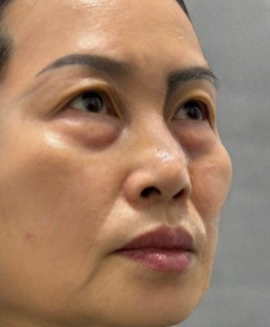 去眼袋手术