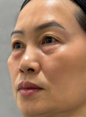 去眼袋手术