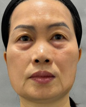 去眼袋手术