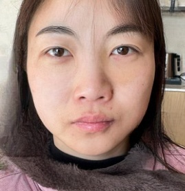 去眼袋手术