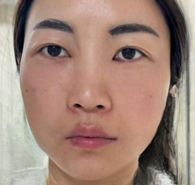 去眼袋手术