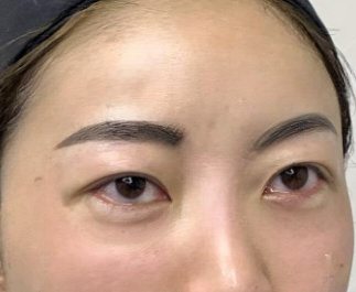 去眼袋手术