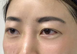 去眼袋手术