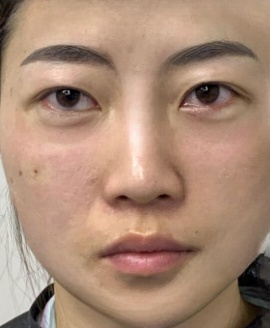 去眼袋手术