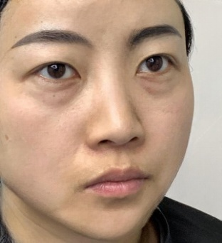 去眼袋手术