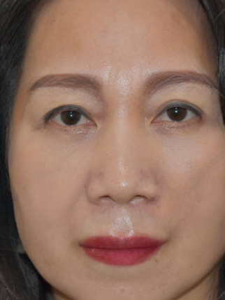 去眼袋手术