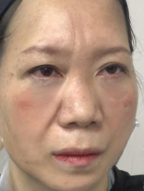 去眼袋手术
