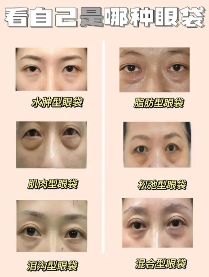 去眼袋手术