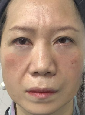 去眼袋手术