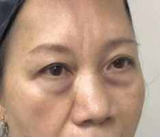 去眼袋手术
