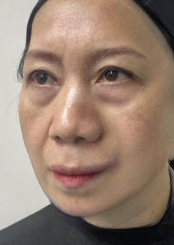 去眼袋手术