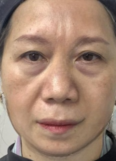 去眼袋手术