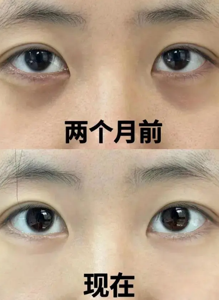 去眼袋手术