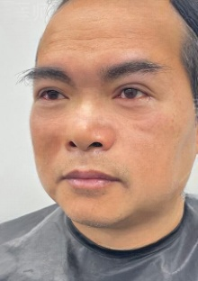 去眼袋手术