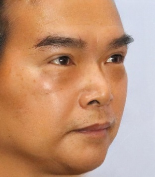 去眼袋手术