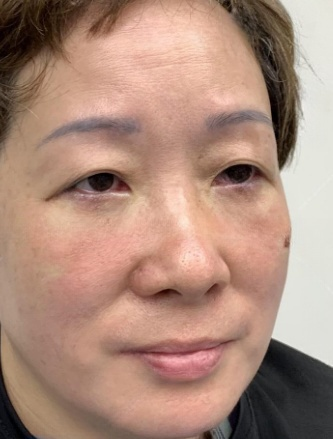 去眼袋手术