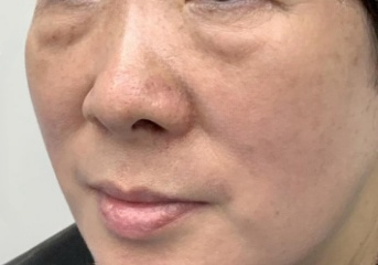 去眼袋手术