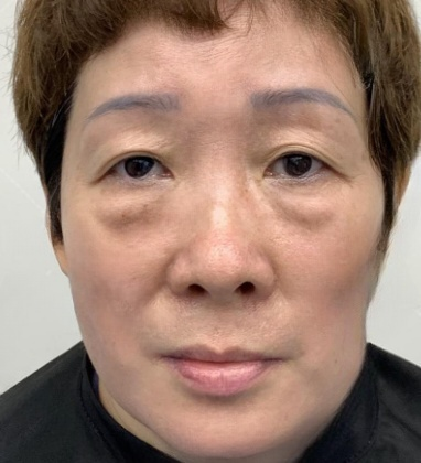 去眼袋手术