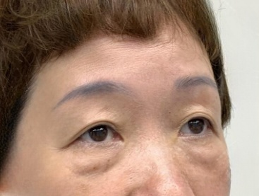 去眼袋手术