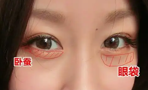 去眼袋手术