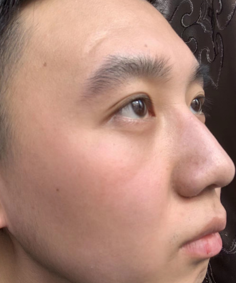 去眼袋手术
